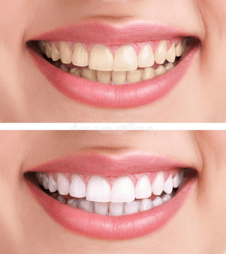 Comparación visual del tono dental antes y después de un blanqueamiento