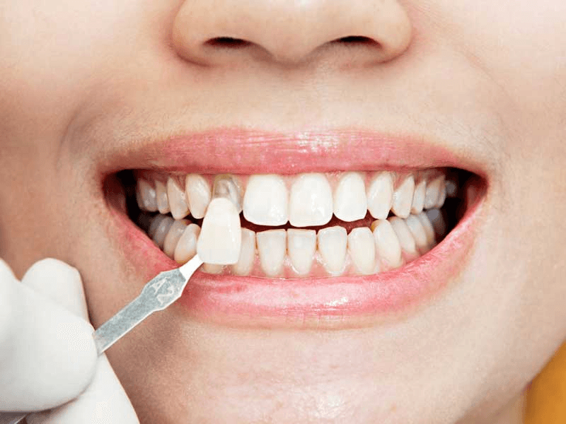 Evaluación del tono dental para un tratamiento estético con carillas