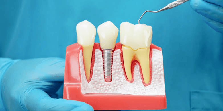 Modelo odontológico utilizado para explicar un tratamiento con implante dental