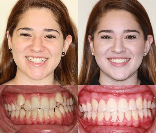 Comparación facial y dental antes y después de un tratamiento de ortodoncia