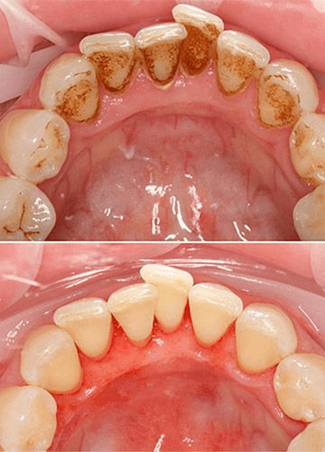 Comparación dental antes y después de una limpieza y profilaxis